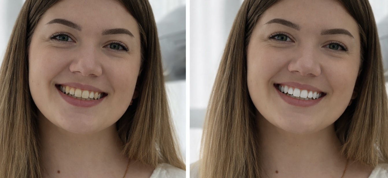 Prima e dopo sbiancamento dentale