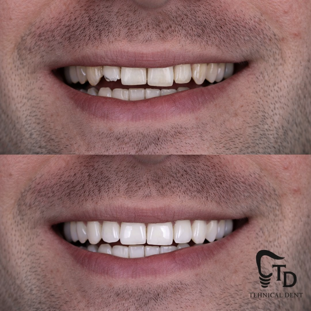 Faccette in ceramica — trasformazione completa