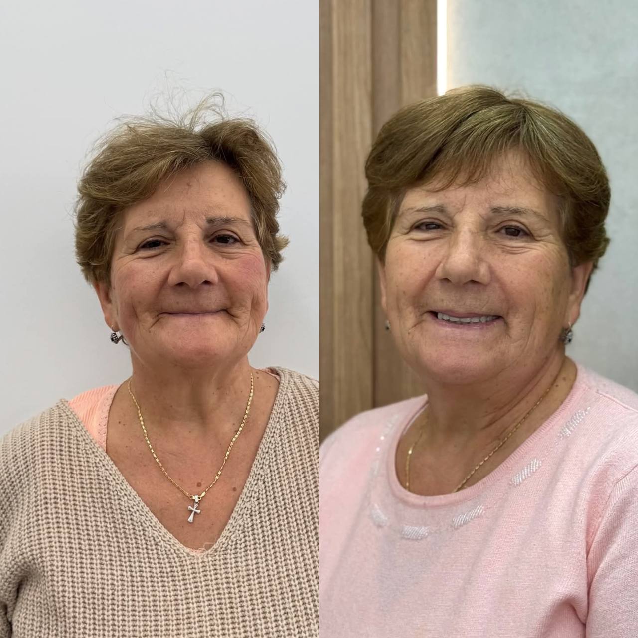 Protesi su impianti — risultato finale